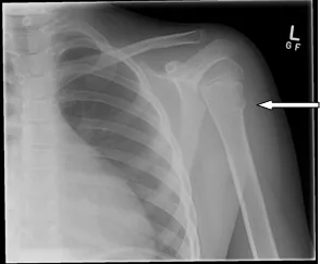 Shoulder X-ray showing a proximal humerus fracture